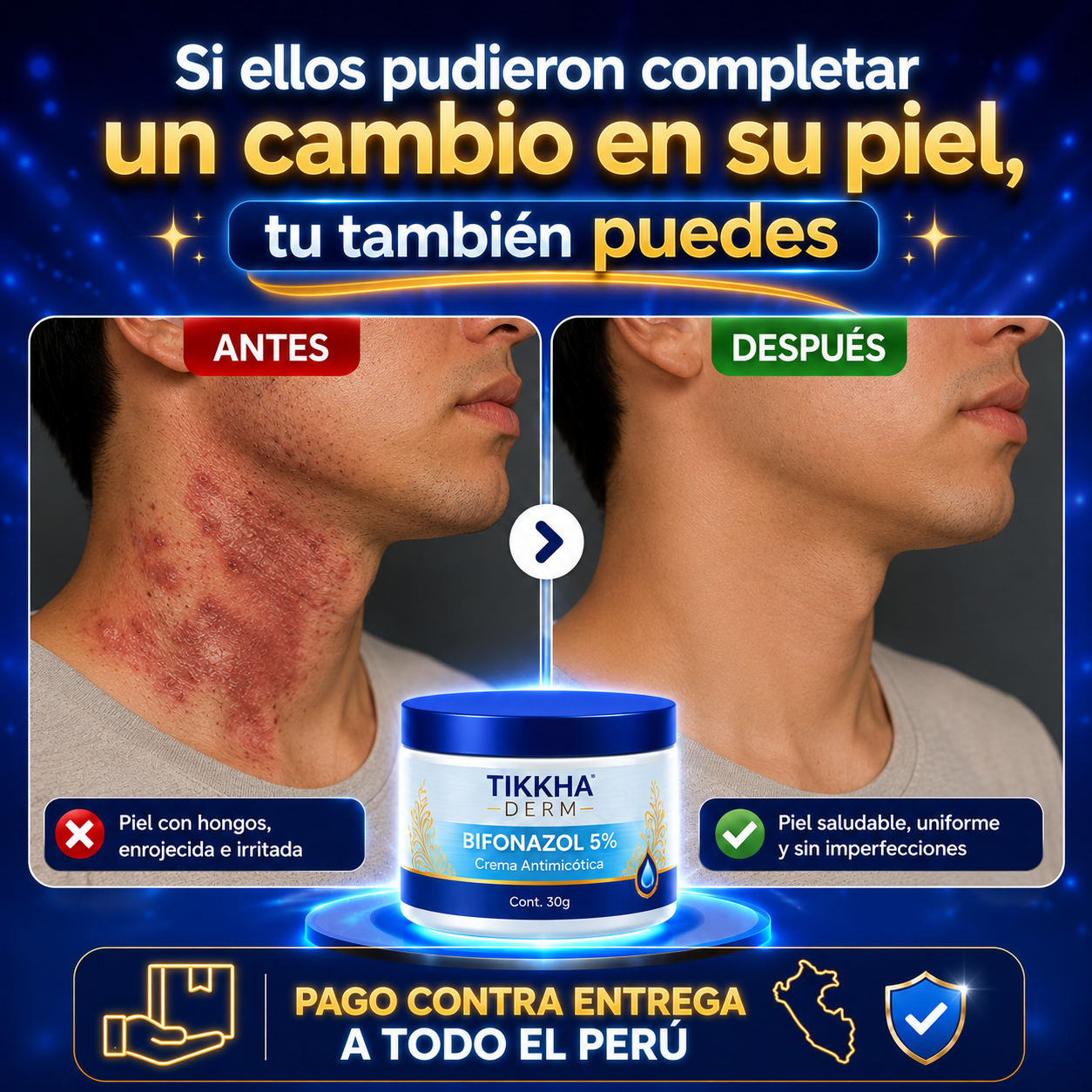 💙✨TIKKHA DERM® BIFONAZOL 5%✨💙